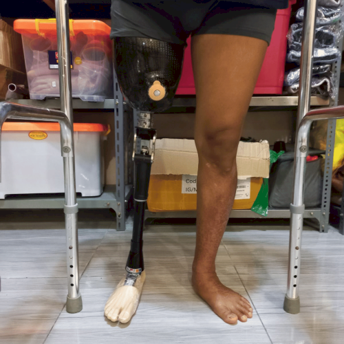 Jasa Pembuatan Kaki Palsu Cirebon