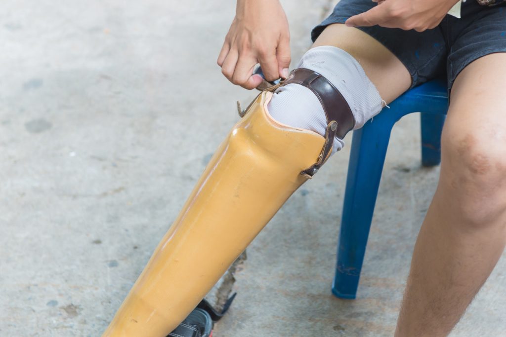 Jasa Pembuatan Kaki Palsu Pekanbaru